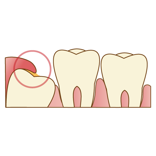 智歯周囲炎の原因と対処法は？